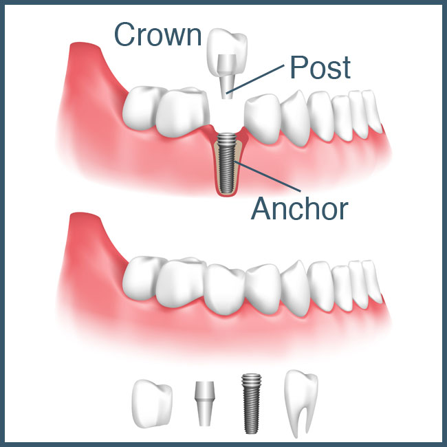 dental-implants-lebanon-nh-hanover-nh-upper-valley-dentist-nh-vt
